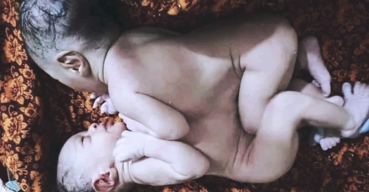 ভোলার লালমোহনে জন্ম নিয়েছে জোড়া লাগানো জমজ শিশু
